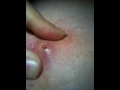 Cyst Part 2