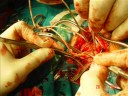 left carotid atheroma