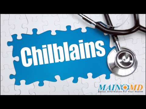 how to cure chilblains