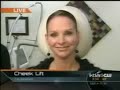 cheek Lift with Radiesse 4