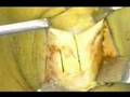 Cirurgia de LCA