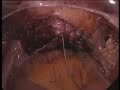 Videolaparoisterectomia dott. biagio orlandi Videolaparoisterectomia dott. biagio orlandi