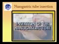 Pediatric NGT