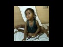 Octopus Girl Lakshim had 8 Limbs in Surgery..