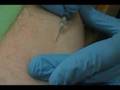 Tuberculosis (TB) Test