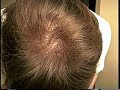 Results With Hair Regrowth using Propecia  (over time)