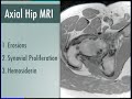 PVNS and SOC Proliferative Diseases of the Synovium