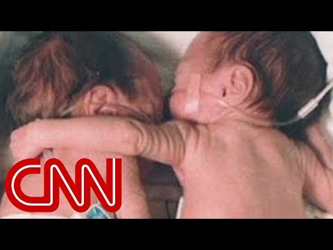 Hug - In 1995, a baby was saved by the hug of her sibling. CNN's Lisa Sylvester reports on a twin bond that has lasted.