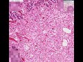 Histopathology Lung--Metastatic adenocarcinoma