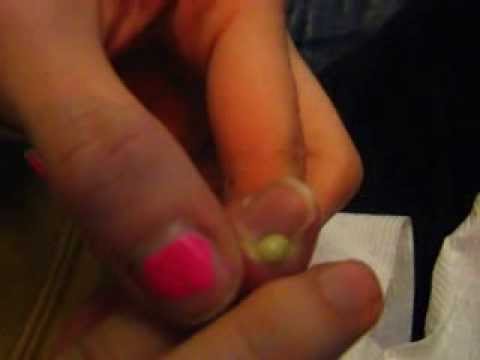 how to drain infected finger