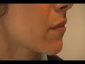 The Acne Practice (after-after 1) The Acne Practice (after-after 1)
