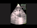 Renal Lymphoma Renal Lymphoma