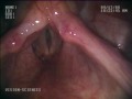 Stroboscopy with the ENT-5000 Flexible Video Laryngoscope, DPU-5050 Digital Processing Unit, and the STR-5000 Stroboscopic Unit.