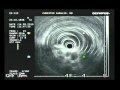 Pseudoachalasia Dilation - Endoscopic Ultrasound Biopsy Pseudoachalasia Dilation - Endoscopic Ultrasound Biopsy