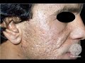 Blemish Scar Video Blemish Scar Video