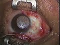 The Use of Amnion Membrane Graft in Pterygium Surgery
