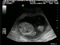 ultrasound