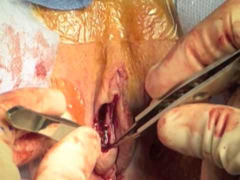 small vagina lips