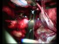Brain Surgery - MCA Aneurysm with Lobar Hemorrhage (Thrace-Greece)