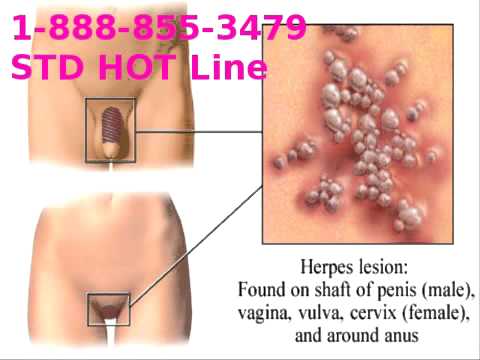 how to cure vdrl positive