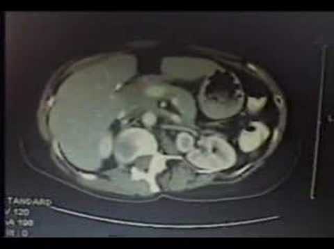 CT Scan Part 2 Non-Hodgekins Cancer ...