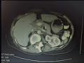 CT Scan Part 2 Non-Hodgekins Cancer Lymphoma