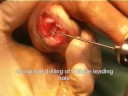 PIPJ arthrodesis.wmv