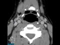 LARYNX CT
