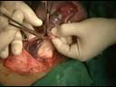 Cirugia de Teratoma de Ovario en una ni�a de 9 a�os.mpg