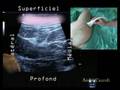 Sonoanatomie Du Nerf Sciatique En Subgluteal