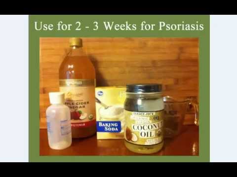 how to relieve psoriasis itching on scalp