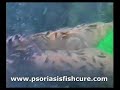 Psoriasis Psoriasis