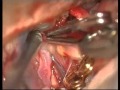 Previously Coiled Aneurysms Microsurgery - Experience on group of 81 patients - Video 4