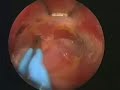 BioDynamic Breast Augmentation Surgery BioDynamic Breast Augmentation Surgery