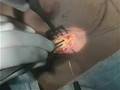 BioDynamic Breast Augmentation Surgery