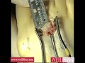 Weil Metatarsal Osteotomy