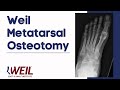 Weil Metatarsal Osteotomy | Weil Foot & Ankle Institute