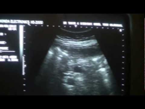 how to locate cbd on ultrasound