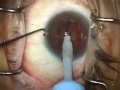 Modern Cataract Surgery, vol. 2