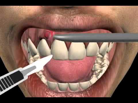 how to relieve dental abscess