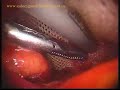 Double ventral hernia -- TAPP laparoscopic mesh repair Double ventral hernia -- TAPP laparoscopic mesh repair