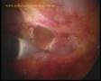 Double ventral hernia -- TAPP laparoscopic mesh repair