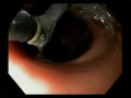 8338GS Endoscopic Sclerotherapy Technique for the Treatment of Dilated Gastrojejunal Anastomosis...
