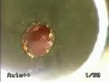 Ventilation tube for ear infections