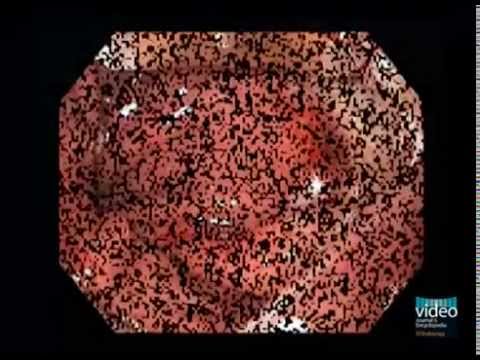 how to cure barrett's oesophagus