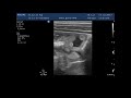 Нажмите для просмотра : Аскаридоз (ascaris lumbricoides)