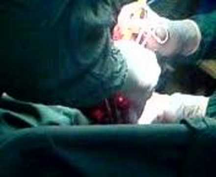 mastectomy