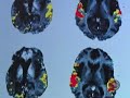 Pacemaker For The Brain? (CBS News)