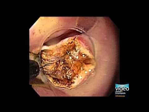 how to treat zenker's diverticulum