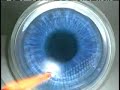 INTRALASE IFS LASER